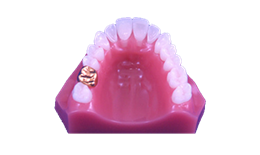 DECB-004 Crown and Bridge