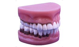 DEPER-002 2x Natural-Size Perio Dontal Disease Demonstration Model