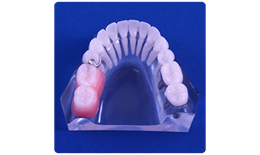 DECB-003 Free-End Defect Implant vs Partial Denture