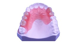 DEDEN-002 Maxillary Non-Clasp Denture