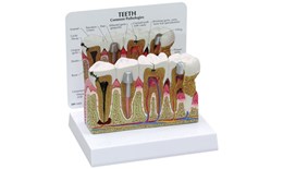 DEPER-004 Perio Dontal Disease and Tooth Disease Model