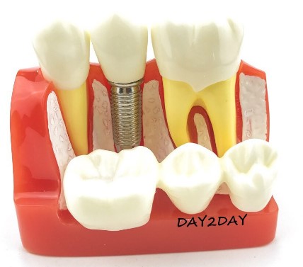 Mẫu hàm mô hình tư vấn so sánh Implant và Cầu răng